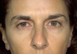 After BOTOX®