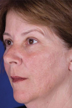 After Laser Skin Resurfacing