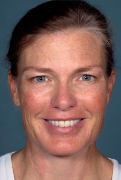 Before Laser Skin Resurfacing