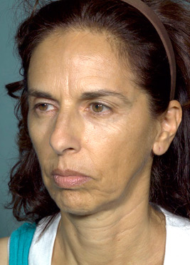 Before Sculptra®