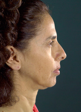 After Sculptra®