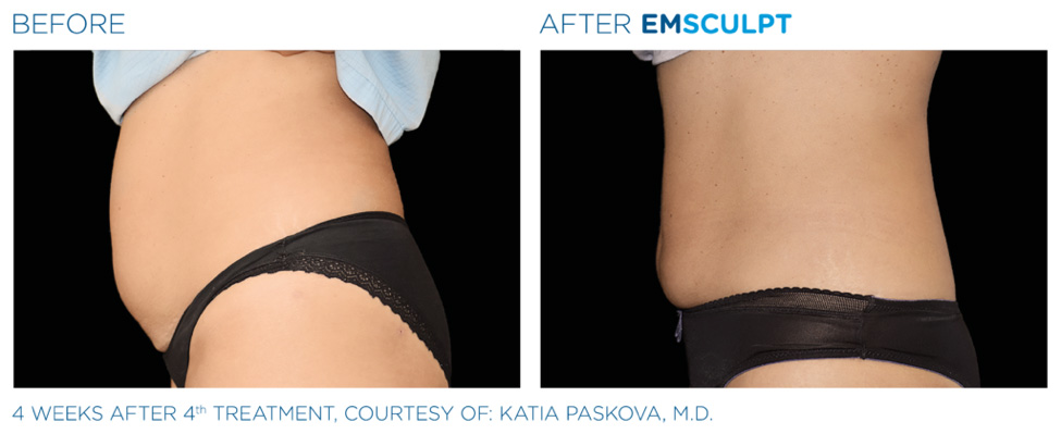 Abdomen before and after 4 treatments of EmSculpt